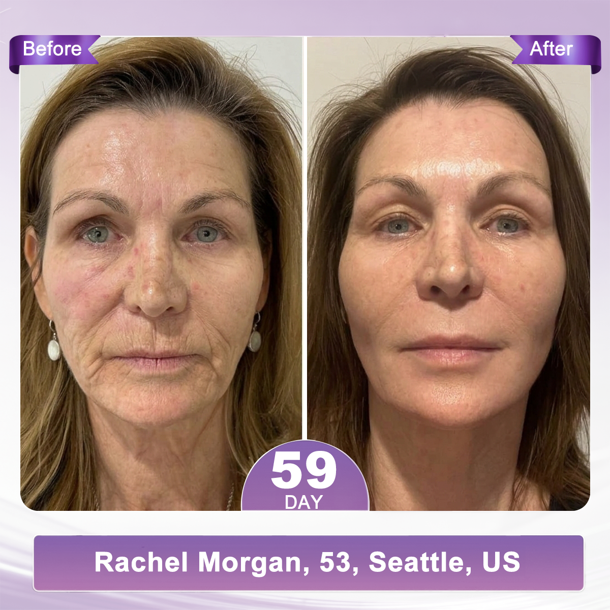 𝐏𝐃𝐑𝐍 𝐌𝐮𝐥𝐭𝐢-𝐏𝐞𝐩𝐭𝐢𝐝𝐞 𝐌𝐚𝐬𝐬𝐚𝐠𝐢𝐧𝐠 𝐁𝐨𝐝𝐲 𝐑𝐨𝐥𝐥𝐞𝐫 𝐂𝐫𝐞𝐚𝐦- Anti-aging, Hydrating, Skin Firming & Lifting, Skin Repair, Even Tone, Acne and Dark Spot Treatment, Wart and Mole Removal, and Psoriasis Relief.