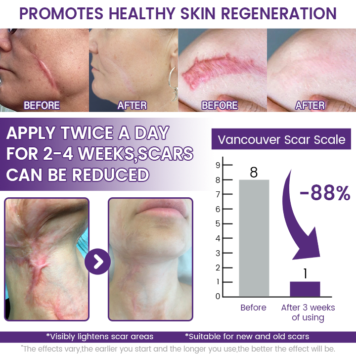 Mirevane® ReGenScar Stem Cell Scar Gel