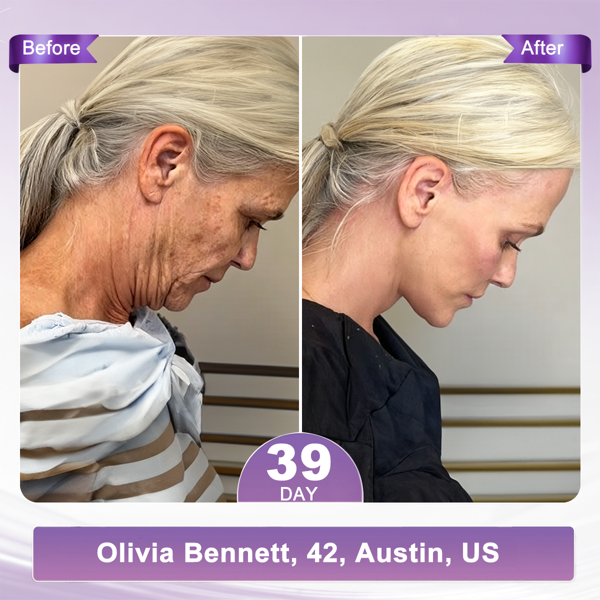 𝐏𝐃𝐑𝐍 𝐌𝐮𝐥𝐭𝐢-𝐏𝐞𝐩𝐭𝐢𝐝𝐞 𝐌𝐚𝐬𝐬𝐚𝐠𝐢𝐧𝐠 𝐁𝐨𝐝𝐲 𝐑𝐨𝐥𝐥𝐞𝐫 𝐂𝐫𝐞𝐚𝐦- Anti-aging, Hydrating, Skin Firming & Lifting, Skin Repair, Even Tone, Acne and Dark Spot Treatment, Wart and Mole Removal, and Psoriasis Relief.